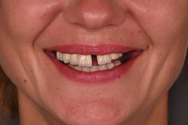 epure geylan - inainte